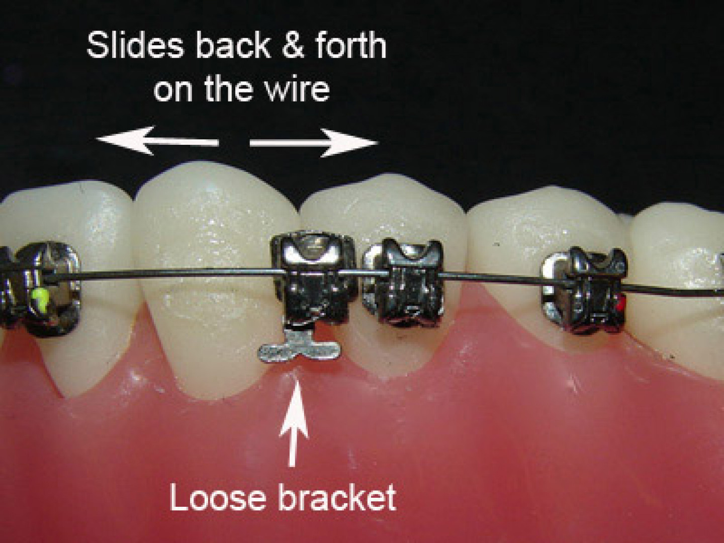 How to Cut Pokey Braces Wire at Home (Video)