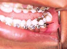 Poking Wire? Here are Some Pointers - Orthodontist Newark