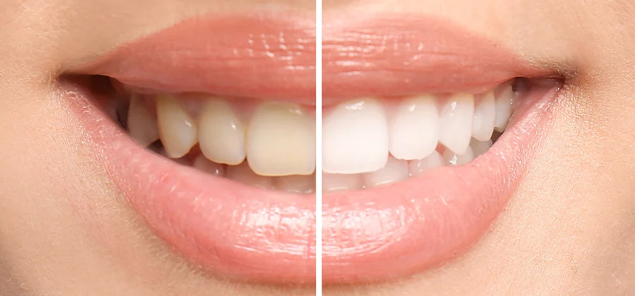 Whitening Before and After