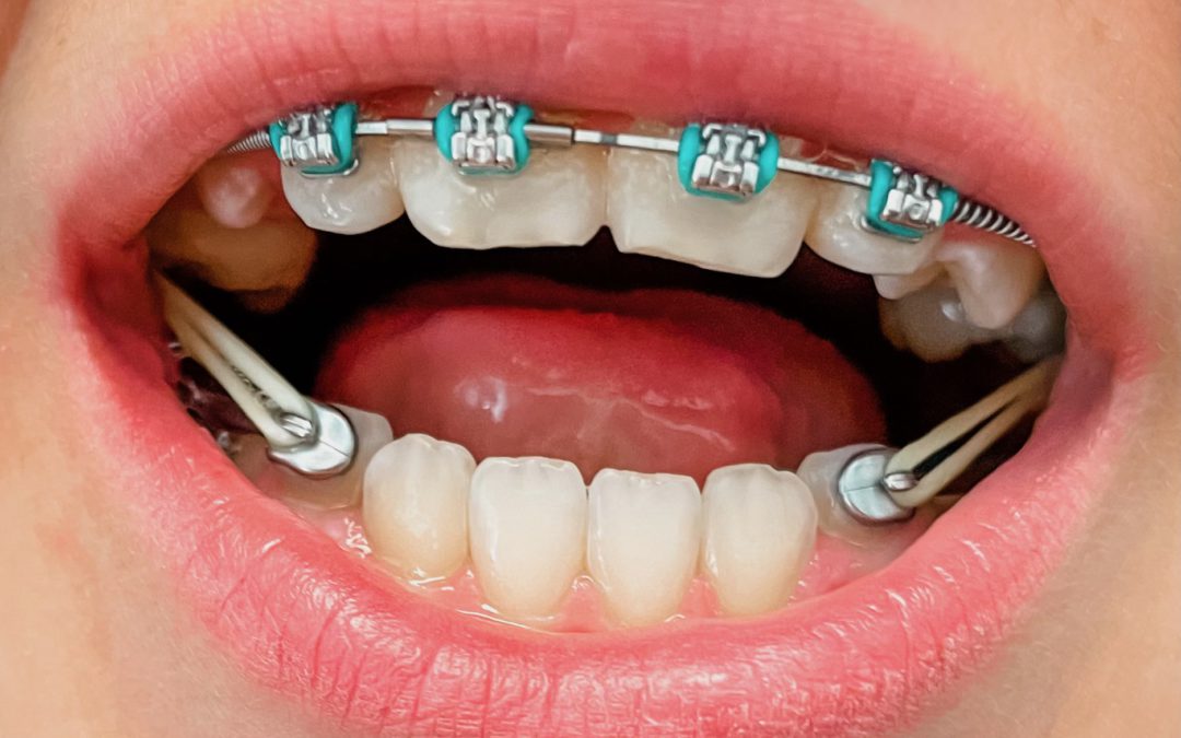Why should you wear your rubber bands?