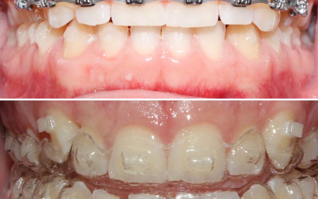 Braces versus Invisalign- which is better?