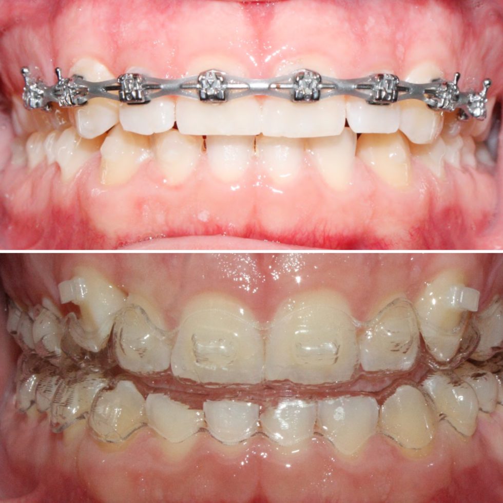 Braces versus Invisalign which is better? Best Orthodontics
