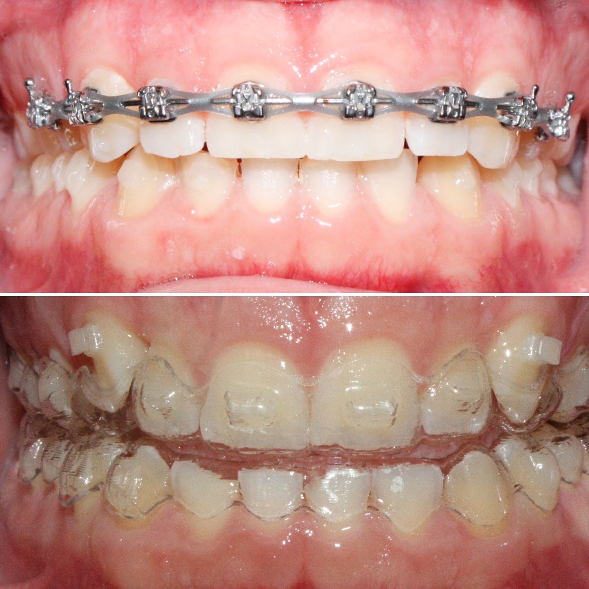 braces vs Invisalign