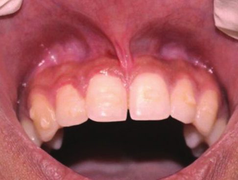 Frenum and whether to address it during orthodontic treatment