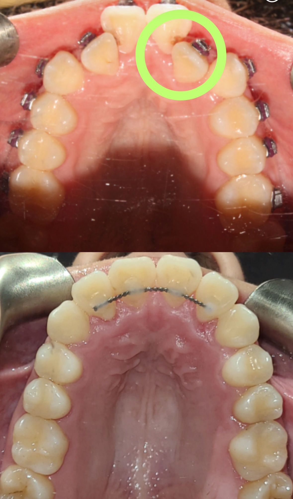 Crooked teeth caused a cavity