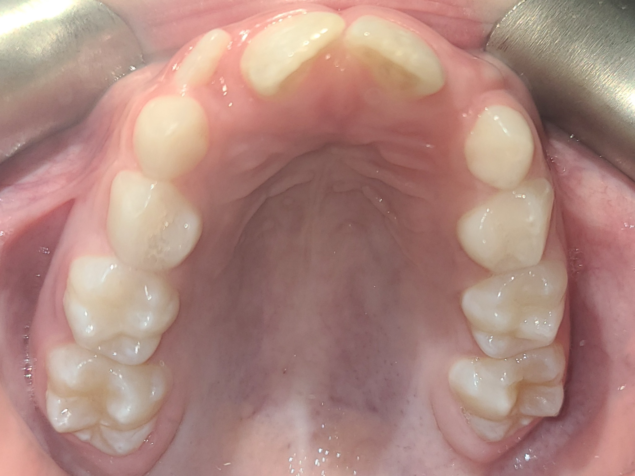 Photo of narrow palate Narrow palate that needs expander