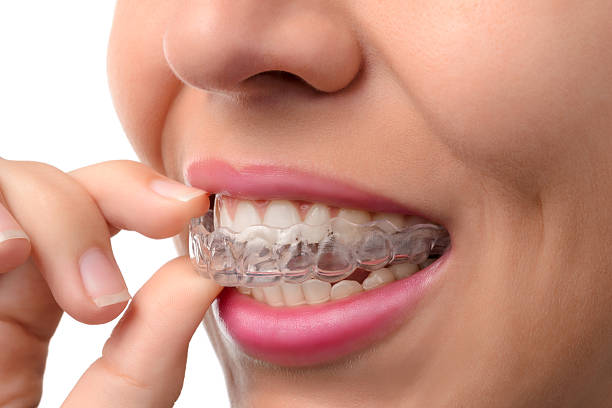 adult wearing Invisalign adult wearing Invisalign